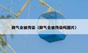 脚气会被传染（脚气会被传染吗图片）